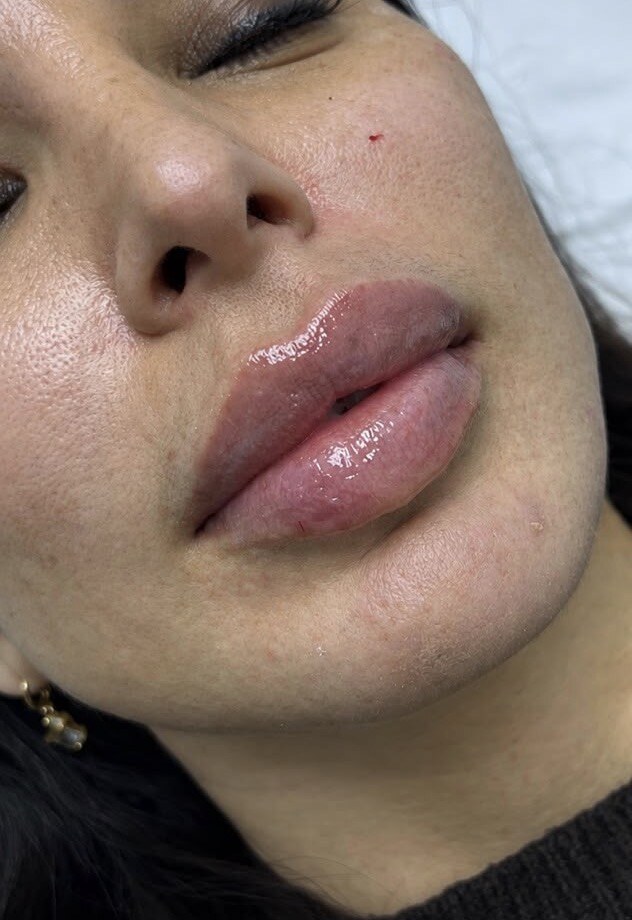 Lip filler