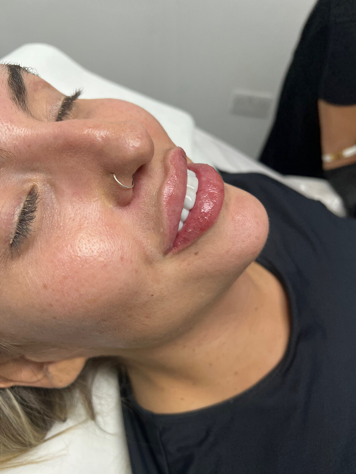 Lip filler