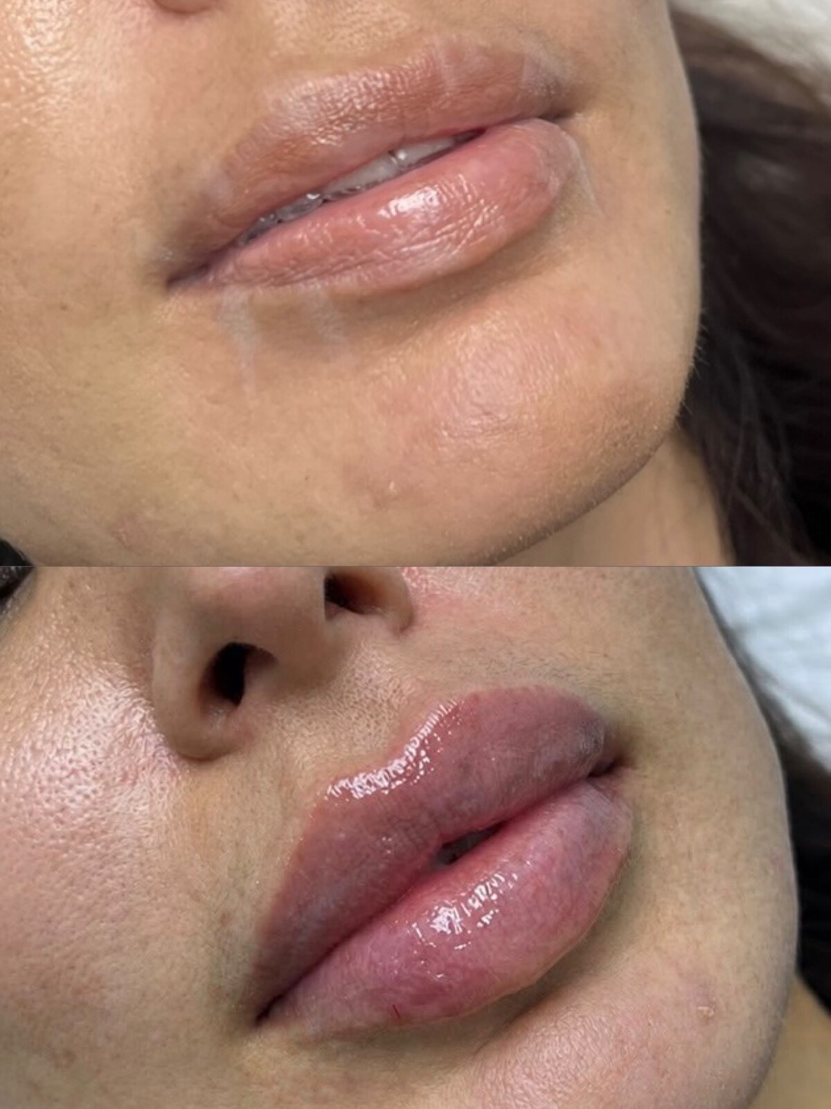 Lip filler