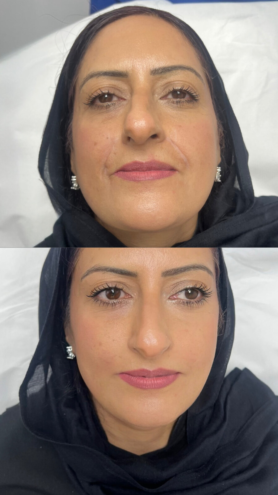 Dermal filler